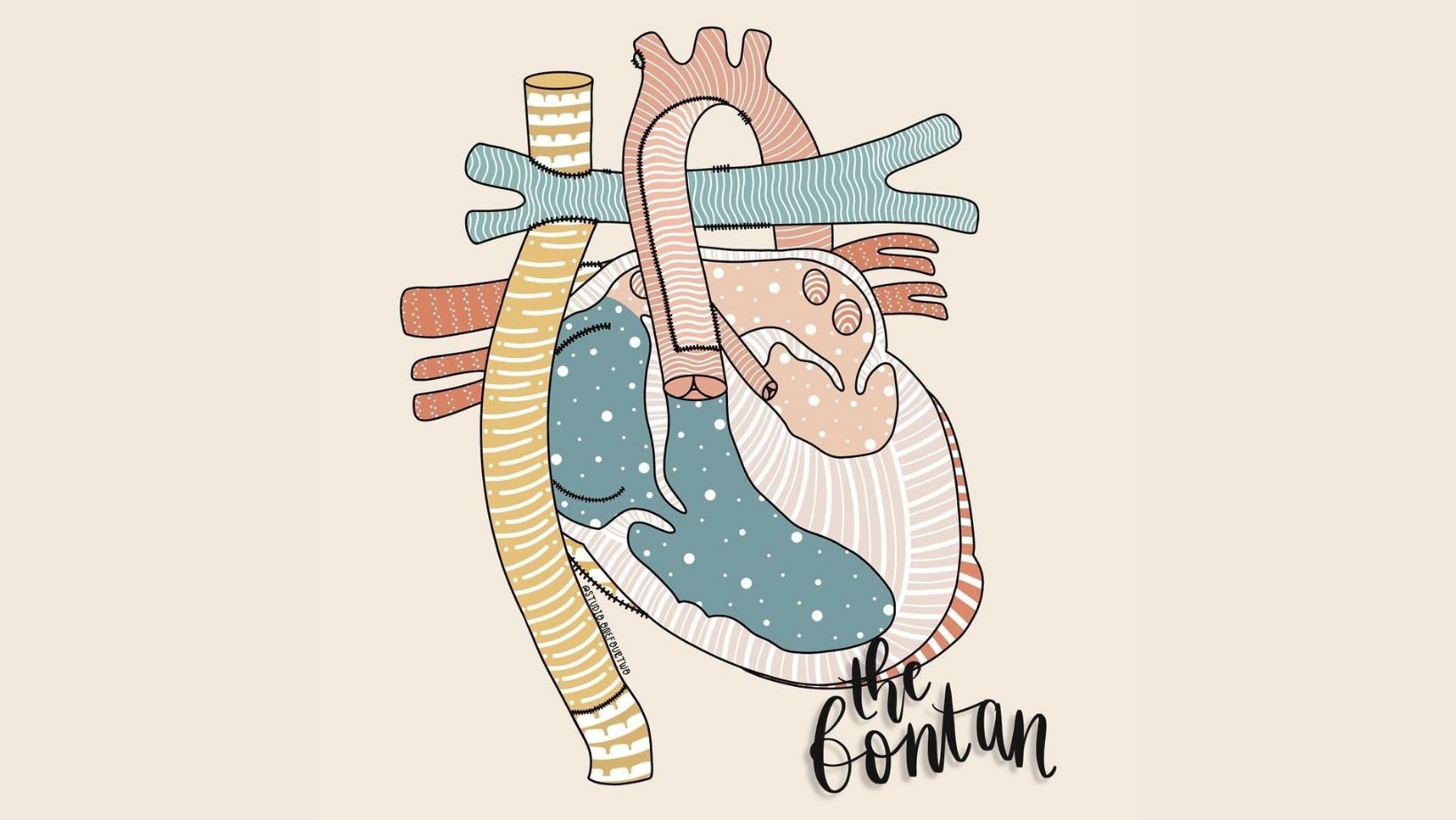 Single Ventricle Heart - definition